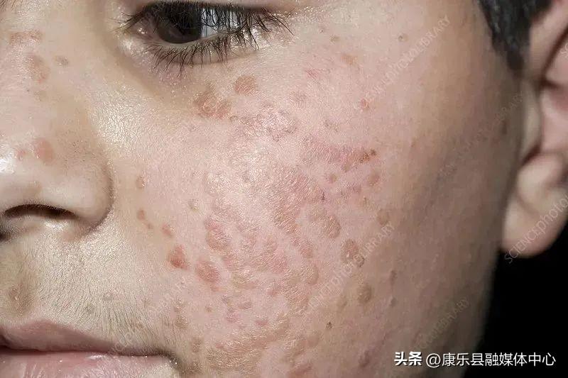 身上長了HPV，我們該如何面對與處理